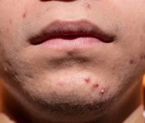 Want to Clear Up Acne Scars? Check out these simple methods! - Byte Topical