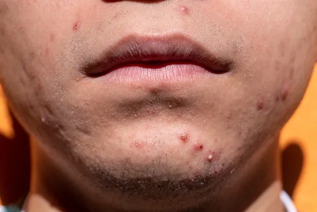 Want to Clear Up Acne Scars? Check out these simple methods! - Byte Topical